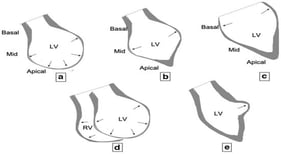“Happy heart syndrome” is associated with a higher rate of the midventricular morphological variant of TTS than “broken heart syndrome”, as assessed by imaging modalities (i.e., echocardiography, cardiac computerized tomography/angiography, and cardiac magnetic resonance imaging); however, this literature finding is based on data from a limited number of patients with “happy heart syndrome”, and thus, this association needs confirmation by further experience. Figure. 1 is reproduced from [29], and reveals 5 different TTS morphological variants (a = apical; b = mid-ventricular; c = basal [aka reverse or inverse]; d = right ventricular in association with apical; e = focal) from left and right systolic ventriculographic images. Left ventricular ejection fraction (LVEF) of patients with the a, b, and c variant is similar, while patients with the e variant have a higher LVEF [30].