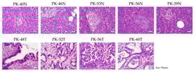 Histopathological features of pancreatic ductal adenocarcinoma tumor (T) tissues and adjacent non-tumor (N) tissues. Representative hematoxylin and eosin staining of patient-derived pancreatic tissues. (Upper panels): adjacent N tissues showing normal acinar architecture and pancreatic islets. (Lower panels): T tissues showing typical features of PDAC, characterized by irregular glandular structures and dense desmoplastic stroma. Scale bars = 50 μm.