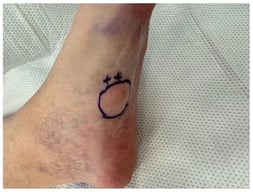 Identification and marking of injection site for lidocaine with epinephrine and enzymatic injection.