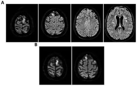MRI of patient 1 group 1. A 74-year-old woman with a history of atrial fibrillation, ischemic heart disease, anxiety-depressive syndrome, and hypertension was found at home in a stuporous state. She had experienced asthenia and fever in the preceding days and had initiated ciprofloxacin treatment. On arrival, laboratory exams showed leukocytosis (11,930/mm3, 90.4% neutrophils), elevated INR (1.92), and markedly increased inflammatory markers. Arterial blood gas revealed hypoxemia (pO2 55 mmHg), requiring mechanical ventilation with 35% FiO2. Brain CT was unremarkable, showing no acute lesions or signs of raised intracranial pressure. Chest CT revealed bilateral posterior-basal consolidations with air bronchograms (more severe on the left), a smaller consolidation in the left upper lobe, and bilateral pleural effusions, consistent with bronchopneumonia. A lumbar puncture was initially contraindicated due to coagulopathy. Due to worsening neurological status (GCS 6), the patient was transferred to the ICU, intubated, and underwent lumbar puncture. On day 2, TCCD showed PI values of 0.62 (right) and 0.71 (left), with no signs suggestive of intracranial hypertension. (A) 3D axial FLAIR sequence shows multiple bilateral hyperintense areas, without mass effect. (B) Some of these present diffusion restriction in axial DWI sequence with the largest located in the left middle and superior frontal gyrus. There is also a subtle pachymeningeal enhancement in the bilateral fronto-temporal region. Supratentorial and infratentorial ventricular system is normal in size and configuration, with no midline shift or hydrocephalus.