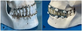 (a) Erich Arch Bars applied to a plastic model with 24 g wire with elastic bands to achieve MMF; (b) Minne Ties Hybrid Arch Bars applied with circumdental Minne Ties to a plastic model with elastic band MMF.