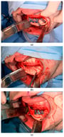 (a)—Placement of titanium cutting guide, (b)—genioplasty cuts demonstrated, (c)—centralising genioplasty fixed with patient-specific titanium plate and fit with patient-specific PEEK mandibular implant. Patient 30. Chin augmentation with the implant and 2 had mandibular PSI in combination with a centralising/rotation genioplasty using a titanium patient guide and patient-specific plate.