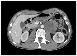 Residual retroperitoneal mass before surgery.