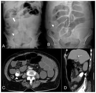(A) Plain abdominal X-ray showing a radiopaque object in the right flank (arrowhead), consistent with a gallstone, along with stepladder-pattern air-fluid levels (thick arrow). (B). Scout view from an abdominal computed tomography (CT) scan demonstrating a gallstone in the right flank (arrowhead) and dilated small bowel loops. (C). Axial contrast-enhanced abdominal CT scan revealing a thick-walled gallbladder containing a large calculus, along with pneumobilia and passage of oral contrast into the gallbladder. (D). Coronal contrast-enhanced abdominal CT scan showing a gallstone at the jejunal level (arrowhead) with a second, smaller adjacent gallstone, as well as pneumobilia (arrow).