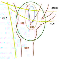 Anatomical Shamblin Scheme. ICA: internal carotid artery; ECA: External carotid artery; CCA: common carotid artery; SLN: superior laryngeal nerve; CN-XII: XII cranial nerve; CN-X: X cranial nerve; blue line: type I; orange line: type II; green line: type III.