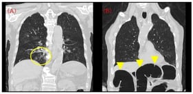 Initial computed tomography (CT) on admission. (A) Chest CT demonstrating mild bronchopneumonia predominantly in the right lower lobe without extensive consolidation or pleural effusion (yellow circle). (B) The same CT series incidentally showing a moderately distended transverse colon with intraluminal gas (yellow arrowhead). This finding was visible on the admission CT but was not pursued with dedicated abdominal evaluation at that time and was later revisited during case review.