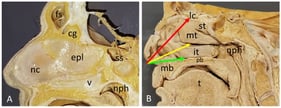 (A) Lateral view of the nasal septum is shown, comprising the nasal cartilage (nc), the vomer bone (v), and the perpendicular plate of the ethmoid bone (epl). Superiorly, the crista galli (cg) process is visible posterior to the frontal sinus (fs). The posterior boundary of the nasal cavity is formed by the sphenoidal sinus (ss) and the nasopharynx (nph). (B) Lateral wall of the nasal cavity. The floor of the nasal cavity is formed by the maxillary bone (mb) and the horizontal plate of the palatine bone (pb). The tongue (t) occupies the oral cavity inferiorly. The nasal septum has been removed to reveal the nasal mucosa covering the inferior, middle, and superior turbinates (it, mt, and st, respectively). Potential swab trajectories are illustrated. Only the green pathway follows the inferior meatus, the narrow passage beneath the inferior turbinate, which leads to the nasopharynx (nph). Alternative trajectories contact the middle turbinate (yellow) or risk impinging upon the ethmoidal air cells (red), towards the fragile lamina cribrosa (lc), resulting in greater patient discomfort and a lower likelihood of obtaining a sample with a high viral load.