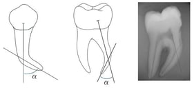Illustration of the Schneider method of evaluation of root curvature (α angle formed between the line parallel to the canal long axis and the line from the apical foramen to the first line).