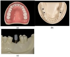 Typodont models used in this study: (a) maxillary model with full dentition; (b) mandibular model with implants positioned in the edentulous posterior sites corresponding to teeth 47, 46, and 36; (c) titanium scan body attached to tooth 36. Tooth designations: 36 (mandibular left first molar), 46 (mandibular right first molar), and 47 (mandibular right second molar).