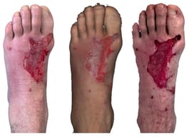 Photograph (left), Artec Eva 3D scan (middle), and Revopoint Miraco 3D scan (right) of the burn on the following day after its occurrence.