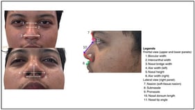 Nasal morphology measurement landmarks.