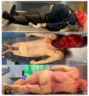 (a–c). The victim, dressed and undressed, in the autopsy room, showing extensive tissue loss only from the base of the neck to the top of the head.