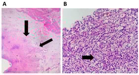 (A) Hematoxylin–eosin-stained section of an early gastric cancer type IIc. The tumor invades the middle third of the submucosal layer and is associated with extensive mature desmoplasia (arrows). Original magnification ×10. (B) The mucosal component of the early gastric cancer contains numerous signet-ring cells (SRC), arranged singly, in cords, or in nests, showing abundant eosinophilic cytoplasm and an eccentric nucleus (arrow). Hematoxylin–eosin-stained section. Original magnification ×100.
