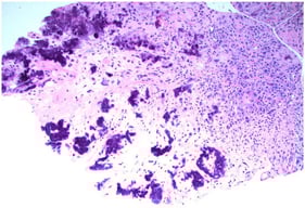 Synovial biopsy sample of calcium pyrophosphate deposition disease (CPPD), stained with hematoxylin and eosin. CPPD crystals are aggregated and appear dark purple. Source: Dr. Ami Ben-Artzi.