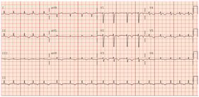 Electrocardiogram showing Diffuse T-wave changes representing ischemia.