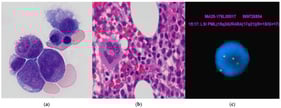 Morphologic and cytogenetic study of APL case with indolent behavior in a treatment naïve individual: (a) bone-marrow aspirate showing APL cells with “figure of 8” nuclear morphology, smooth chromatin, and cytoplasmic hot pink granules (×1000); (b) bone-marrow core biopsy demonstrates increased promyelocytes/blasts in a background of decreased trilineage maturing hematopoiesis (×1000); (c) PML::RARA FISH study shows PML::RARA fusion signal in yellow (PML-red/RARA-green).