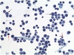 Pap, 400×. ThinPrep cytology reveals many large atypical lymphoid cells in a background of scattered small mature lymphocytes. The atypical cells show round to slightly irregular nuclear contours, open chromatin, and prominent nucleoli. Red arrows highlight background small, mature lymphocytes. Black arrows highlight large, atypical lymphoid cells.