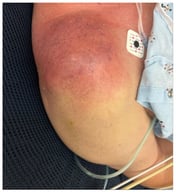 Right shoulder at initial presentation demonstrating marked erythema and edema.