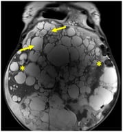 ADPKD body phenotype. Representative MRI scan demonstrating marked organomegaly in ADPKD. Axial MRI image showing bilateral massively enlarged polycystic kidneys (asterisks) and multiple hepatic cysts (arrows), characteristic of advanced ADPKD with severe organomegaly. Note the displacement of adjacent structures and significant reduction in available abdominal cavity space for other organs.