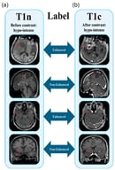Labeling workflow: non-contrast T1WI (a) used for feature extraction, contrast-enhanced T1WI (b) as ground truth for generation of radiologist-verified binary labels (red arrow, enhanced = 1, non-enhanced = 0), to be predicted from non-contrast imaging.