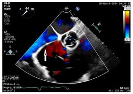 Transoeasophageal echocardiography displaying the cor triatriatum dexter membrane (white arrow) subdividing the right atrium into two chambers.