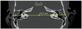 Axial high-resolution CT of the temporal bones showing measurement of the bitemporal distance (mm) using a line tangent to the lateral semicircular canals.