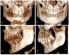 A 42-year-old Caucasian woman presented for consultation because of a mispositioned chin implant placed elsewhere four years earlier (A). She complained of asymmetry, palpable implant mobility, tissue irritation, and mild pain. CT showed implant malposition due to lack of fixation (A,C), with bone resorption and ectopic bone formation (B,D). The patient was scheduled for implant removal with immediate osteoplasty and placement of a custom-made PEEK chin implant.