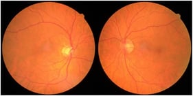 Fundus photo of a patient with early MacTel Type 2 changes, showing a subtle grayish area temporal to the fovea in the right eye. Cup-to-disc ratio asymmetry is noted. OCT demonstrated bilateral features. Images correspond with scans A and B from Figure 2.