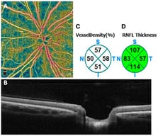 Example of peripapillary OCT and OCTA scan. Panel (A): En-face visualization of peripapillary vascular network with color-coded vessel density; Panel (B): Peripapillary OCT B-scan example; Panel (C): OCTA-derived peripapillary vessel density for superior (S), inferior (I), temporal (T) and nasal (N) quadrants (in %); Panel (D): OCT-derived peripapillary RNFL thickness for superior (S), inferior (I), temporal (T) and nasal (N) quadrants (in μm). OCT: optical coherence tomography; OCTA: OCT angiography; RNFL: retinal nerve fiber layer.
