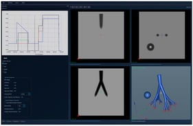 Theoretical lungs model—unsegmented (two separated regions with similar HU intensities, with one of them being a tracheobronchial tree with “red” structures-HU outside the lung parenchyma interval-protruding outside the lung).