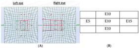 Orthoptic examination at the first visit: (A). Hess–Weiss chart showing a decreased function of the left lateral rectus muscle and a marked overaction (Red arrows) of the medial rectus in the right eye. (B). Ocular deviation figure of the paretic left eye.