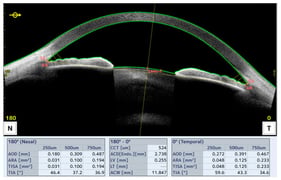 Example of anterior segment measurement by Casia2 device in a patient before the cataract surgery.