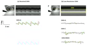 Results of automated OKN detection. (a) The Pupil Neon eye-tracker and eye camera video. (b) An example of a stereotypical well-resolved OKN found from a single eye. The figure shows an image from the eye camera with a horizontal line indicating the source of pixels used to form the cross-sectional view. Below the cross-section is the gaze signal obtained from the Pupil Neon eye-tracker, along with automated OKN detection results. The 1D signals are shown with detected slow phases (green) amd quick phases (red) superimposed. (b) Low resolution OKN. In this case, small amplitude/high frequency oscillations were seen in the eye camera video (see cross-sectional view and area within the dashed line). However, these oscillations are not readily apparent using OKN-G. Output from the OKN-C and OKN-MMIC methods reveals additional instances of OKN.