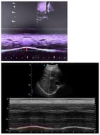 Representative ultrasound image showing diaphragmatic excursion assessed using M-mode. The grayscale B-mode image (upper panel) illustrates probe positioning and diaphragm visualization, while the M-mode tracing (lower panel) depicts diaphragmatic motion over time. The colored horizontal line represents the baseline position of the diaphragm at end-expiration, and the colored vertical line indicates the maximal diaphragmatic displacement during inspiration. Diaphragmatic excursion was calculated as the distance between baseline and maximal inspiratory displacement.
