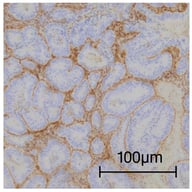 General view of areas with EAH/EIN, showing loss of PTEN expression, with the positive internal control of the stromal cells.
