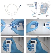 (a) Passio™ IPC Catheter, (b) Passio™ Digital Drainage System, (c) how to attach the catheter connector to the valve, (d) attaching the removable pump head to the handheld control unit, (e) “Priming” phase of the handheld control unit, and (f) selection of speeds 1–4 using the +/− buttons on the handheld control unit (images obtained from Bearpac Medical with permission).