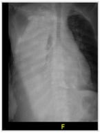 Routine chest x-ray showing significant right-sided pleural effusion with a blunting of right costophrenic angle, yet no obvious evidence of midline shift.