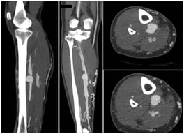 The CT angiogram shows the aneurysm of the posterior tibial artery with AV fistula (contrast uptake by the deep and the superficial veins).