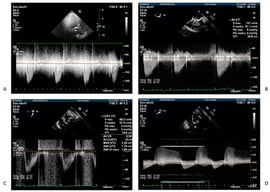 Four examples of different shapes of ascending aorta flow Doppler tracings. (A) Continuous Wave (CW) Doppler trace recorded from transthoracic apical 3-chambers (A3C) view. (B,D) CW Doppler trace recorded from transesophageal deep transgastric long axis view. (C) Pulsed Wave (PW) Doppler from a transesophageal deep transgastric long axis view.