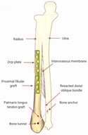 Schematic illustration of complex distal forearm reconstruction using a proximal fibular bone autograft combined with distal oblique bundle (DOB) reconstruction, performed with an autologous palmaris longus tendon graft fixed to the ulna using a metallic anchor.