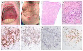 Clinical and pathologic presentation of the extranodal NK/T-cell lymphoma. Clinical photographs showing mucosal lesions in the oral cavity (A) and generalized papular and nodular cutaneous lesions (B). Skin punch biopsy from the back, revealing a patchy dermal infiltrate with a perivascular distribution ((C), H&amp;E stain, 10×). The atypical lymphocytic infiltrate exhibits an angiocentric pattern and consists of neoplastic lymphoid cells of medium to large size, interspersed with histiocytes and small lymphoid cells. ((D), H&amp;E stain, 40×). Immunohistochemistry (IHC) of skin biopsy confirm positive expression of (E) CD3, (F) CD56, (G) perforin (IHC, 40× each), and (H) EBV RNA (RNAscope, 40×).