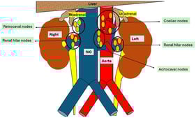 Lymphatic drainage of the adrenal glands. Abbreviation: IVC—inferior vena cava.
