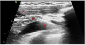 Long-axis (in plane) view of axillary vein after insertion of a J-tip guide wire; note the ability to visualize the full course of the wire in this view (red marks).