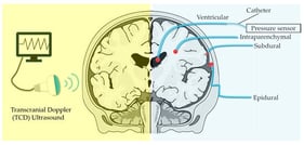Representative methods of invasive and non-invasive methods for ICP monitoring.