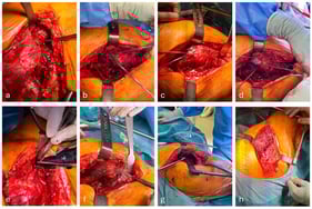 Step by step illustration of abductor repair, using Arthrex FiberTape. Abductor deficiency visualised in a patient with an intertrochanteric neck of femur fracture (a). FiberTape weaved through the proximal abductors (b). Double whipstitch weaved along the edges of the abductors, gaining control of the abductor tendon (c). Cerclage wire tensed in a figure of eight, passed through an interosseus, tunned in the greater trochanter (d). FiberTape cerclage tensioned around femoral shaft with proximal FiberTape passed through the tensioner loop. It is essential to tie the proximal FiberTape while the FiberTape cerclage is held under tension (e). Complete reconstruction of abductors visualised (f). Femoral canal prepped for cemented hemiarthroplasty (g). Final construct demonstrating abductor repair with a cemented hemiarthroplasty stem in situ (h).