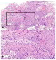 Representative histologic section of cervical squamous cell carcinoma. Neoplastic cells (arrow) show an infiltrative growth pattern within a reactive stroma rich in inflammatory cells [Hematoxylin &amp; Eosin stain. (A) Original magnification 100×; (B) Original magnification 200×, corresponding to the area outlined by the black box in (A)]. (Source: Original figure created by the authors for this review).