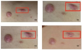 Clinical images of the thoracic keloid at four time points: T0 (baseline), T1 (~30 days), T2 (~60 days), and T3 (~90 days) after initiation of PDL treatment. The standardized 4 × 4 mm region of interest (ROI) analyzed by D-OCT is indicated in red. Progressive softening, flattening, and reduction in erythema are visible over time, which is in line with the quantitative D-OCT findings.