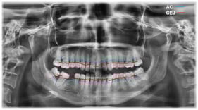 Orthopantomographic image of a patient with periodontitis. Showing an average distance of 4–5 mm between the most coronal portion of the alveolar bone crest (AC) and the cementoenamel junction (CEJ), indicative of alveolar bone loss.