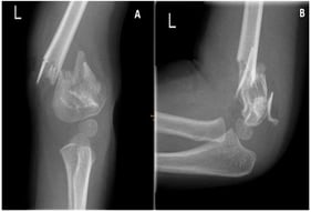 Images of the fracture. (A) A.p. image shows complete dislocation, lateral and medial comminution. (B) Lateral image also depicting multiple fragments.