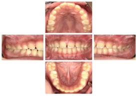 Intraoral examination findings (age 8 years 9 months).